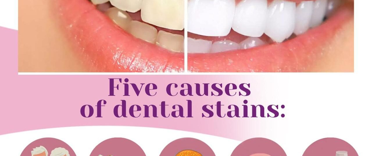 Did you know dental stains have different causes? Keep your smile bright and healthy!