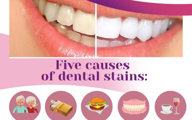 Did you know dental stains have different causes? Keep your smile bright and healthy!